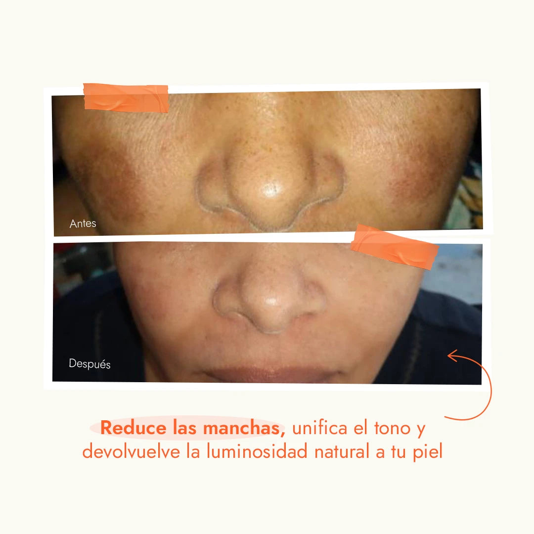 Comparación antes y después del uso de Vitamina C de Onix Skincare, mostrando reducción de manchas y unificación del tono para una piel más luminosa.